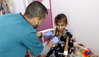 طفلة يمنية تعاني سوء تغذية (محمد حمود/ Getty)