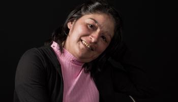 ياسمين امرأة مكسيكية تعرضت للحمض الكاوي (عمر توريس/ فرانس برس)