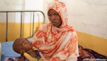 طفل يعاني من سوء التغذية في مستشفى دولو العام بإقليم غدو 