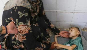 سوء التغذية الحاد يفتك بأطفال غزة (أشرف أبو عمرة/ الأناضول)