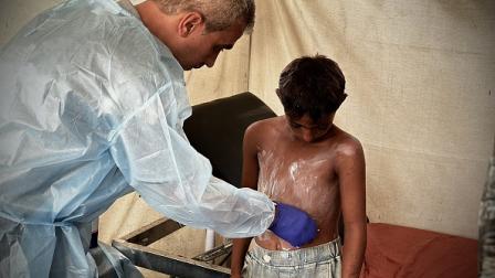 تنتشر الأمراض الجلدية في مخيمات غزة، يونيو 2024 (الأناضول)